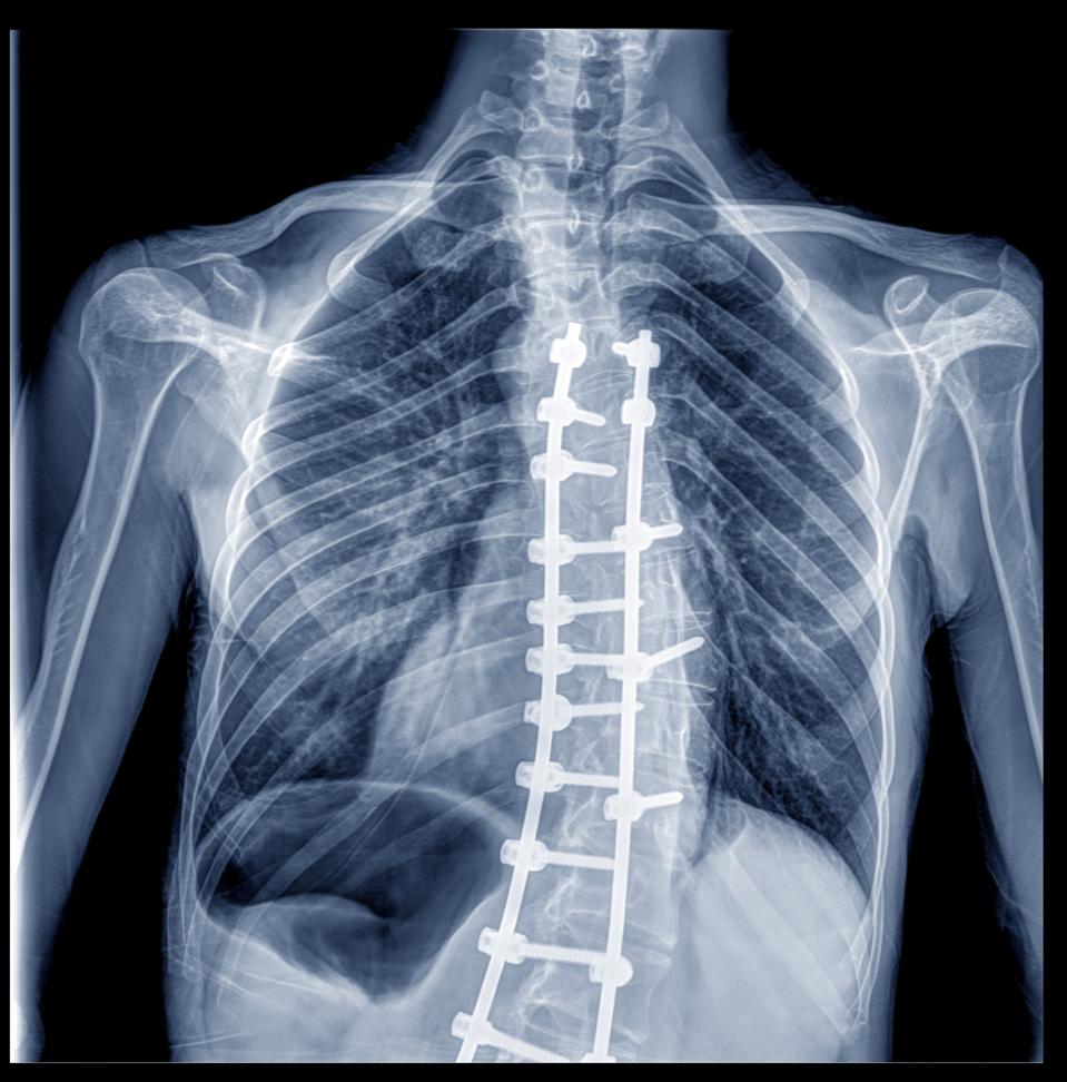How Safe Is Spine Surgery? What To Know And What To Ask Your Surgeon