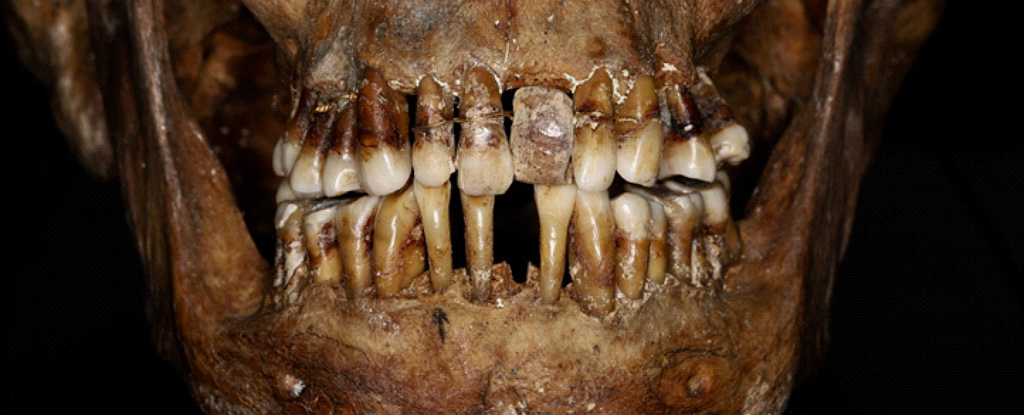 This 17th-Century Aristocrat Had a Clever Secret For Keeping Her Teeth : ScienceAlert