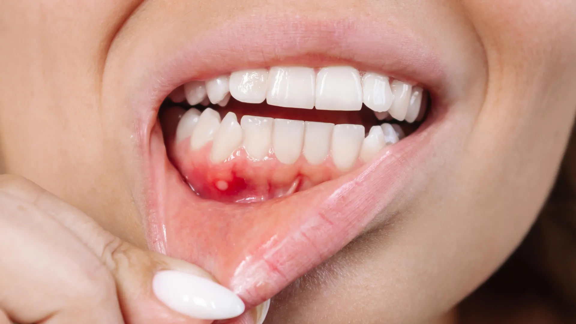 A plant compound might be the secret weapon against gum disease