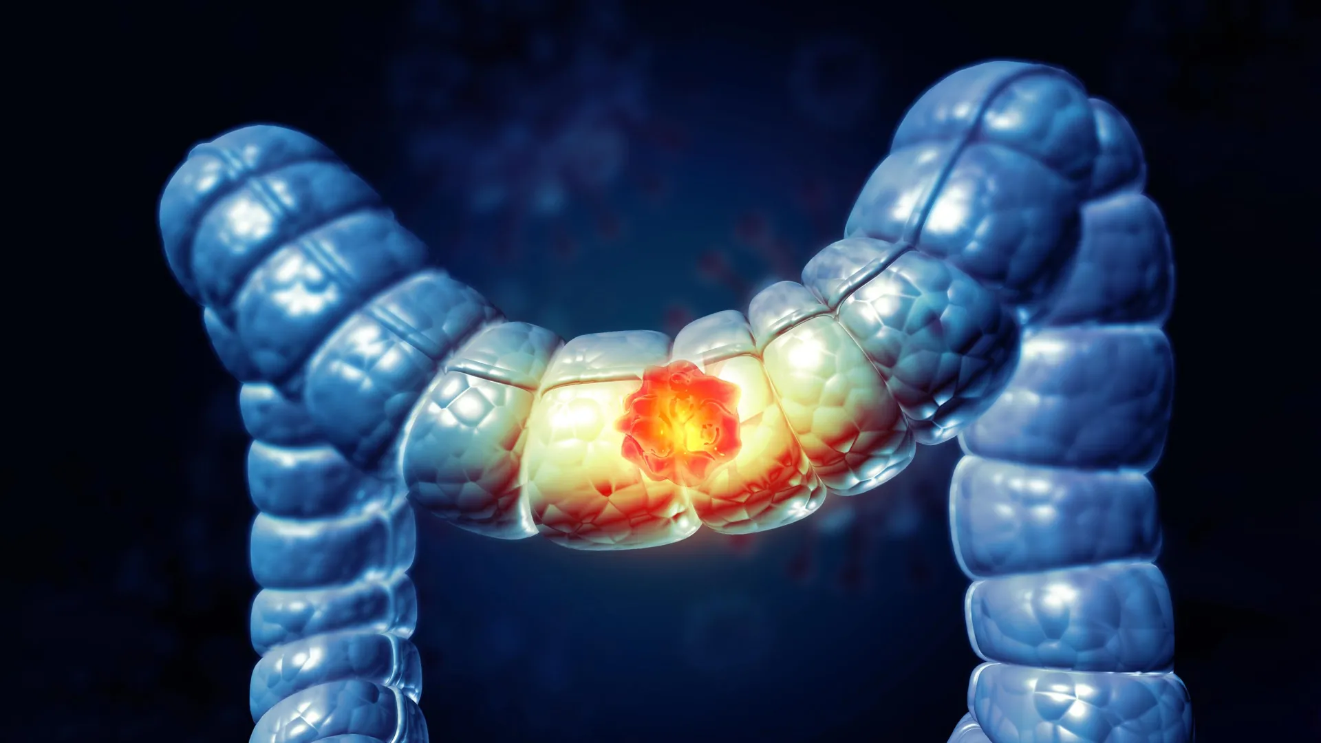 Most Americans don’t know this food raises colon cancer risk