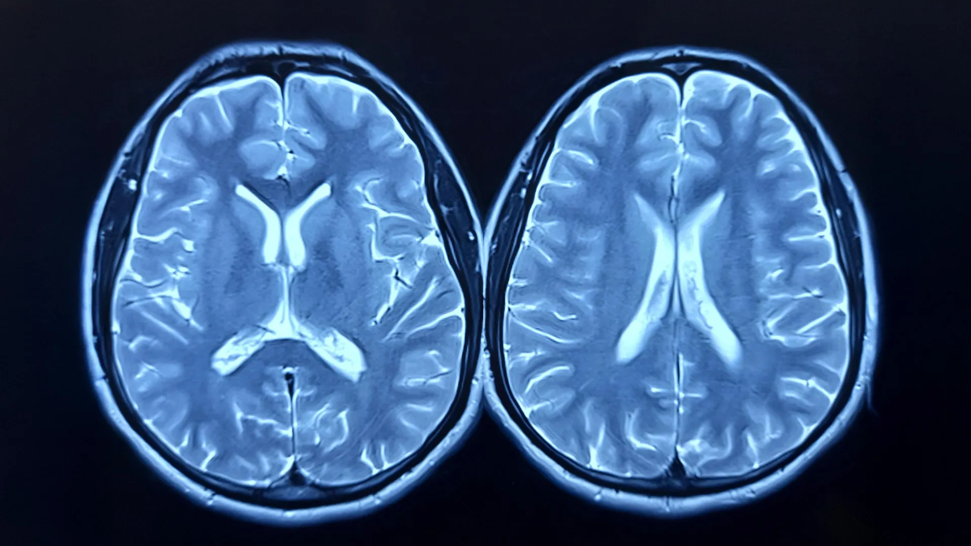 MRI scans show exercise can make the brain look younger