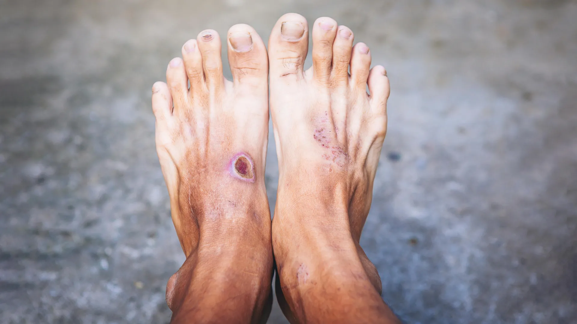 A global DNA study reveals a hidden threat in diabetic foot infections