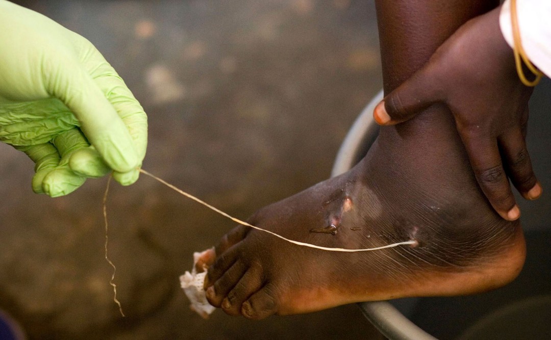 World Creeps Closer to Eradicating a Loathed Parasite