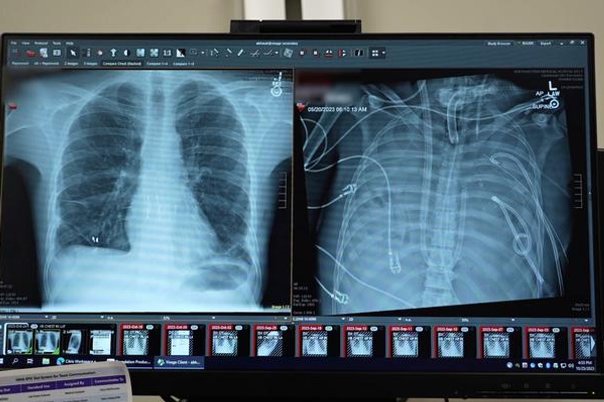 How Surgeons Kept a Man With No Lungs Alive for Two Days