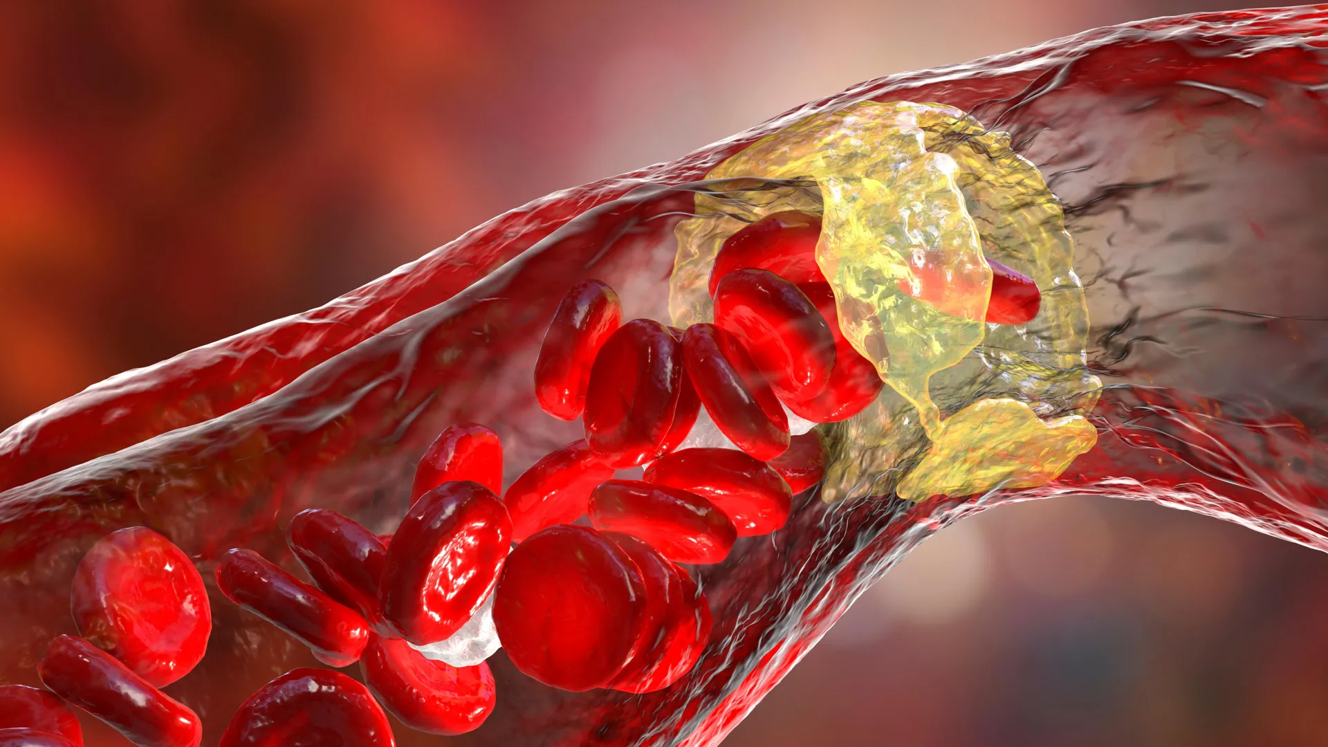 Powerful cholesterol drug cuts heart attack risk by 31%